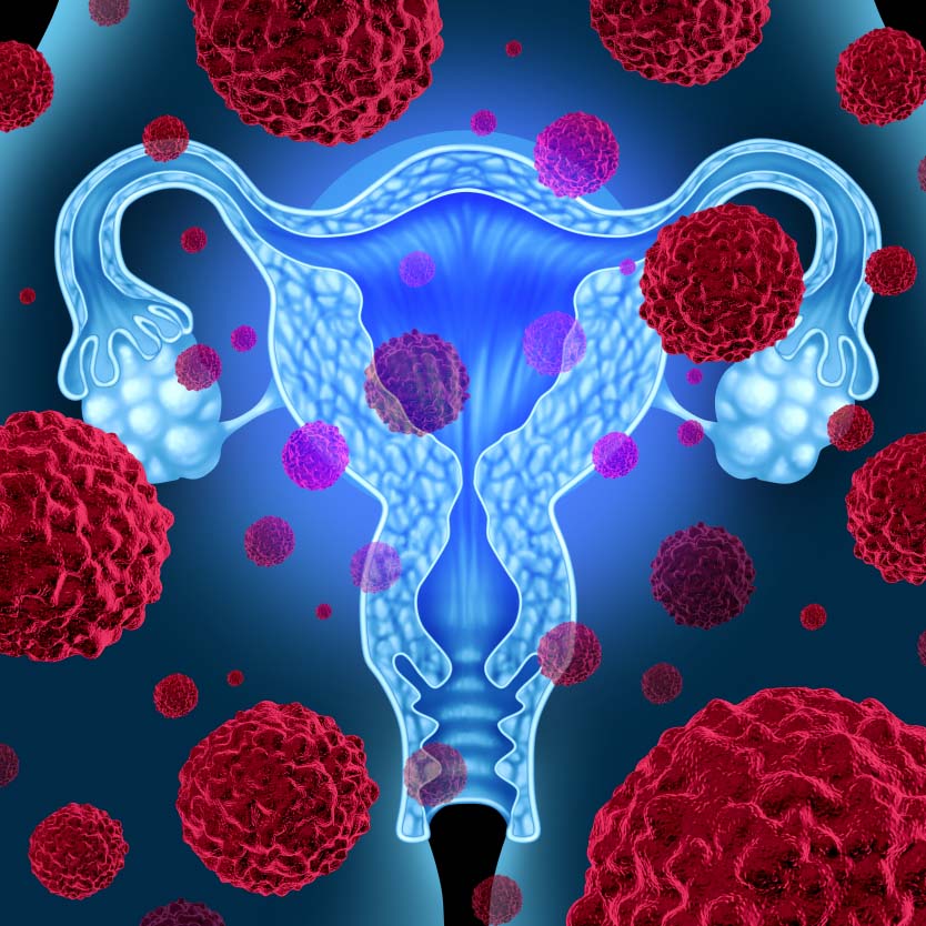 Ovarian <a href='/cancer/'>Cancer</a>