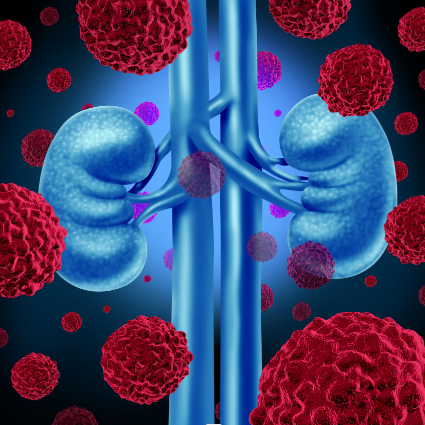 Renal <a href='/carcinoma/'>Carcinoma</a>